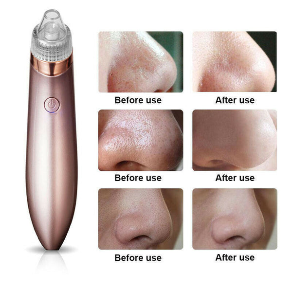 Blackhead Vacuum Pore Cleaner